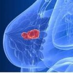 Breast cancer