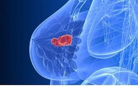 Breast cancer